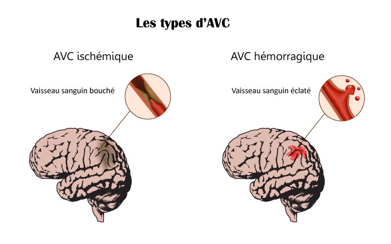  types d'AVC