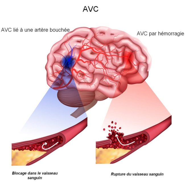 l'AVC hémorragique