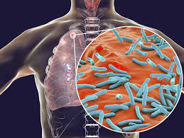 M tuberculosis