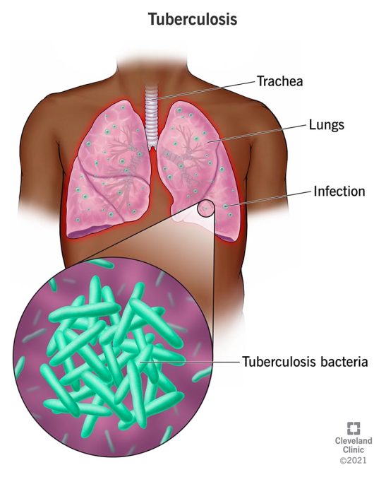 M tuberculosis