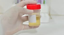 Urine prélévé pour le test d'urine