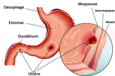 Les maux d’estomac