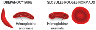 La Drépanocytose