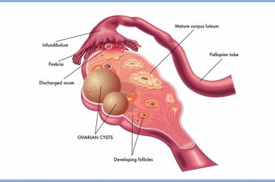 Les Kystes ovariens