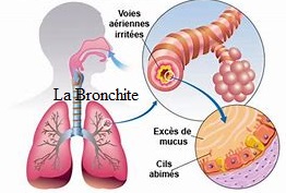 Bronchite chronique
