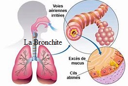 la bronchite