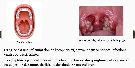 Description de l’angine