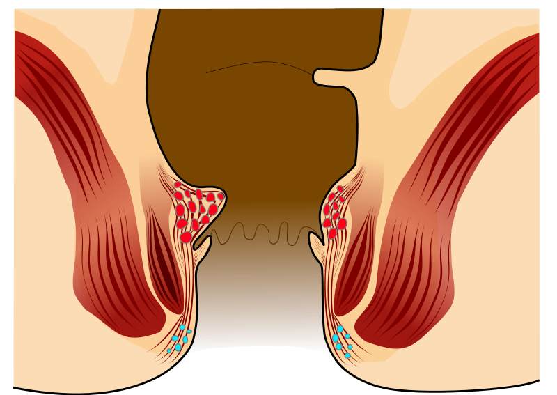 Hémorroïde int