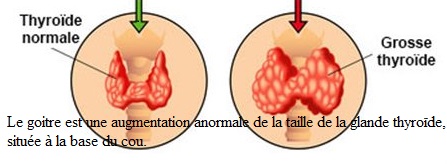 Le goitre