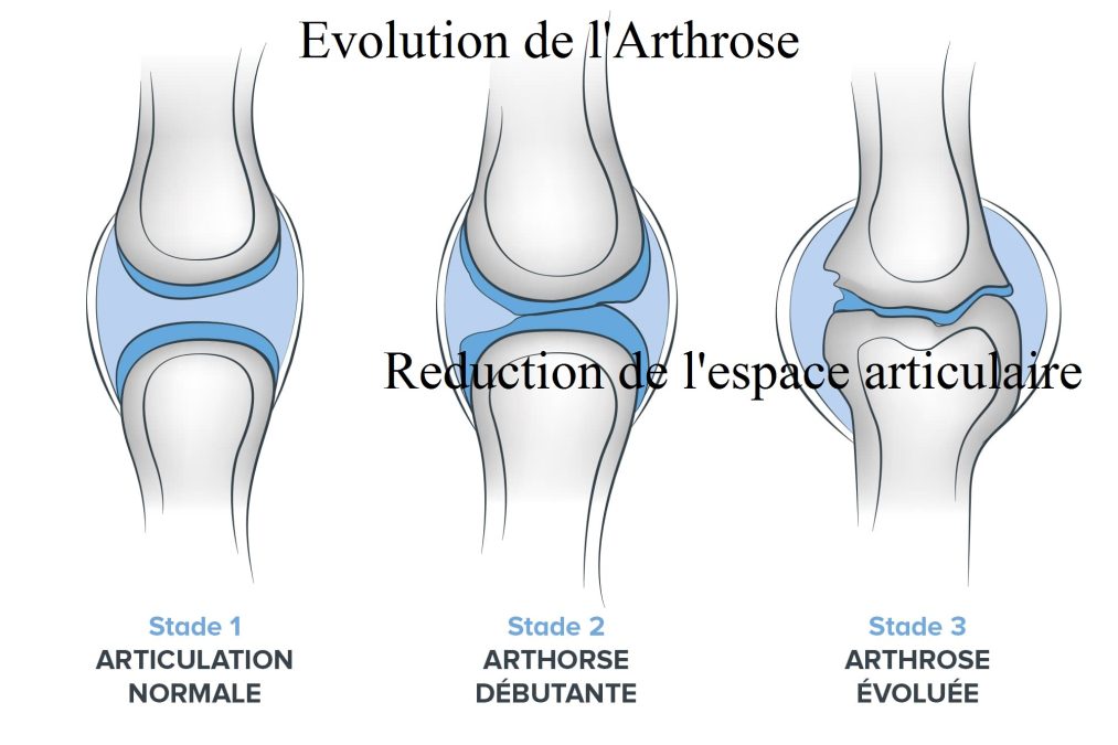 arthrose